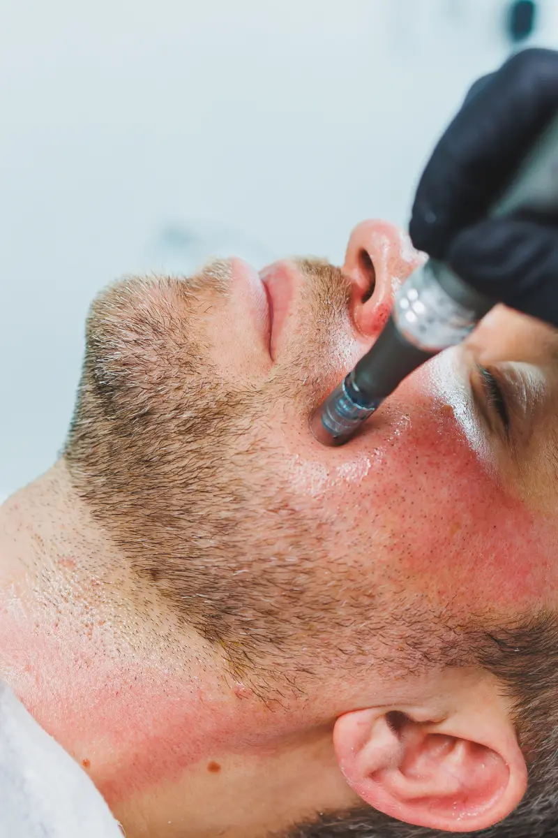 facial-treatment-using-microdermabrasion-tool-on-m-2026-03-25-09-47-13-utc