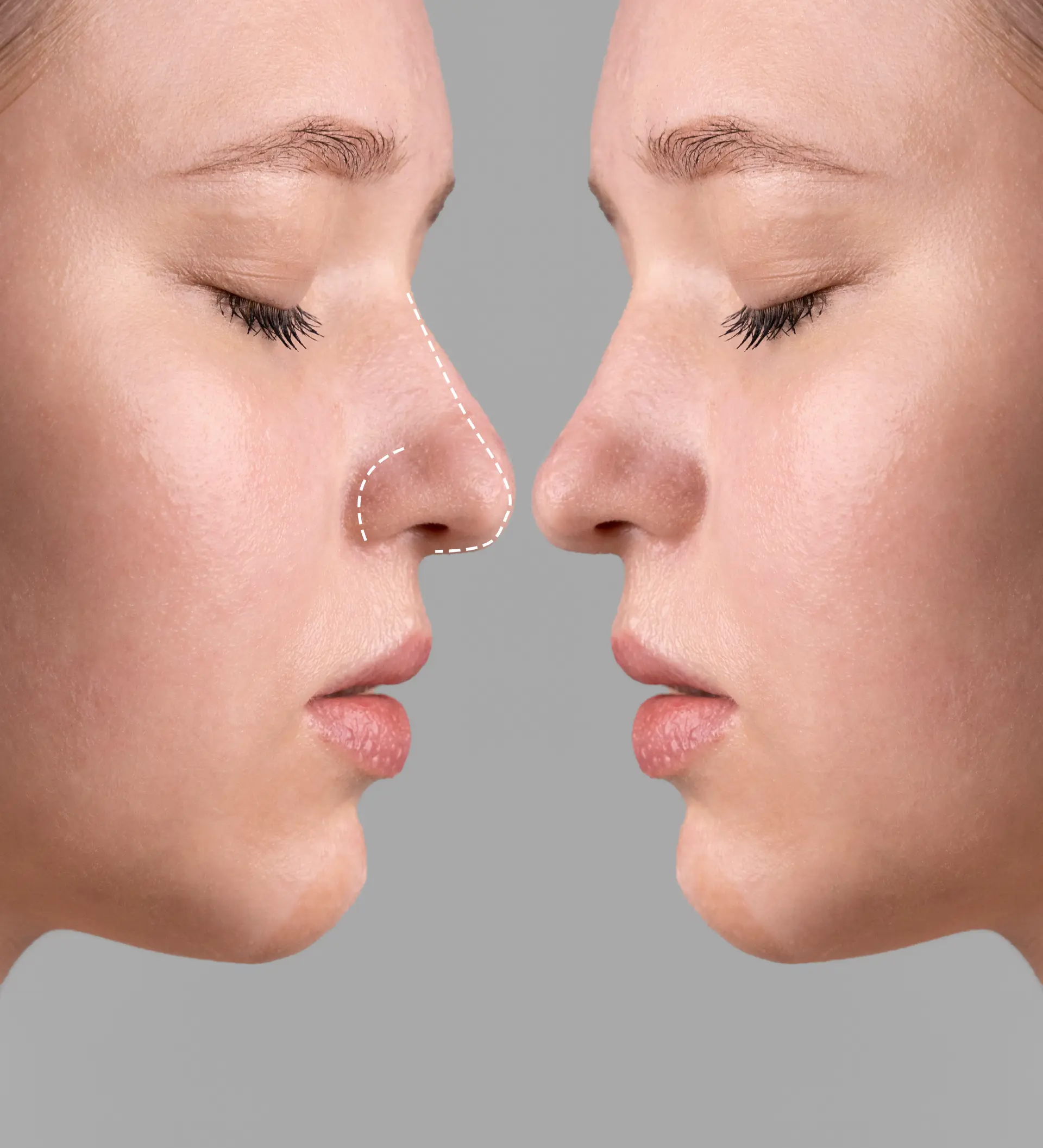rhinoplasty-surgery-concept-with-woman-model