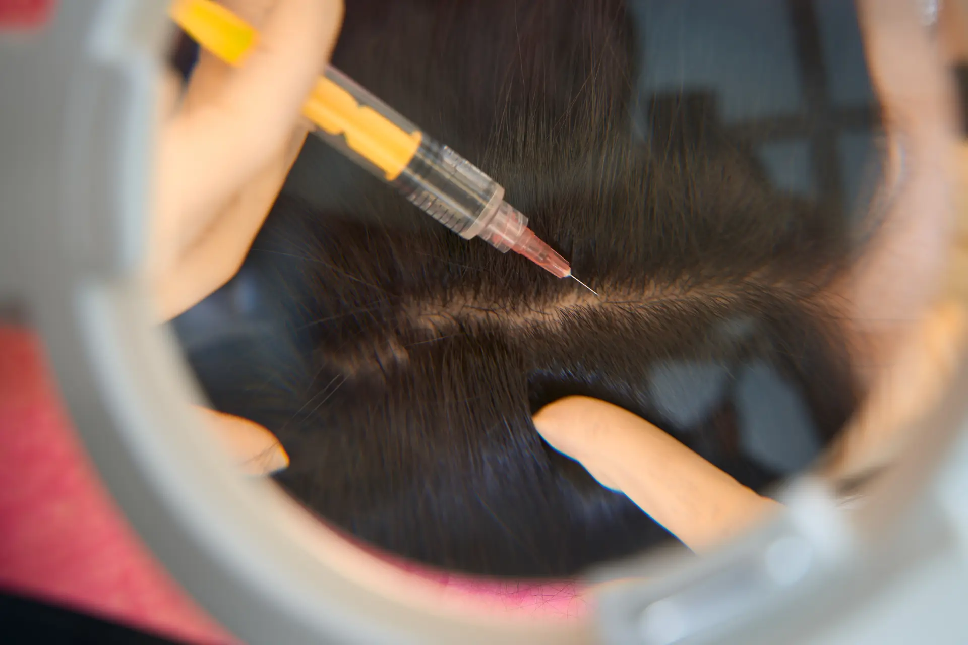 scalp-injection-procedure-for-hair-growth-2026-03-19-21-36-53-utc