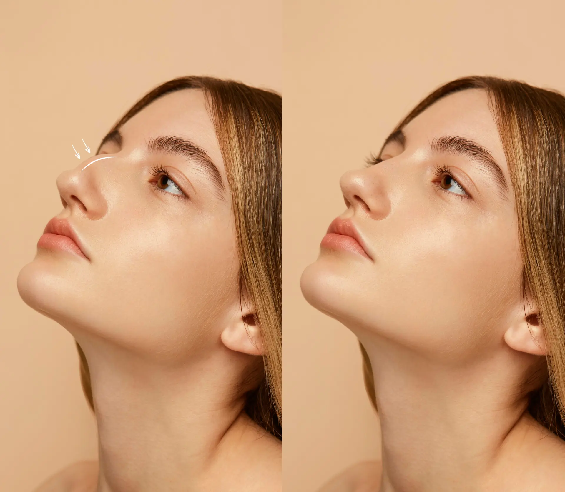 woman-getting-ready-nose-job-surgery